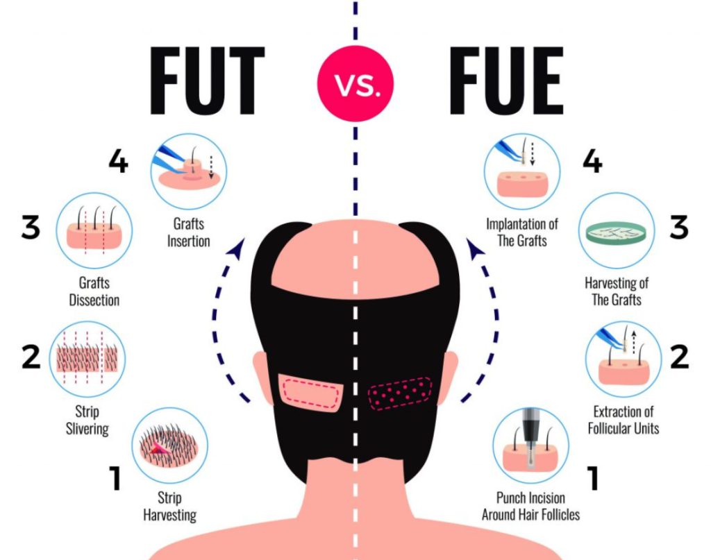 Everything You Need to Know About Hair Transplant [All Questions Answered]