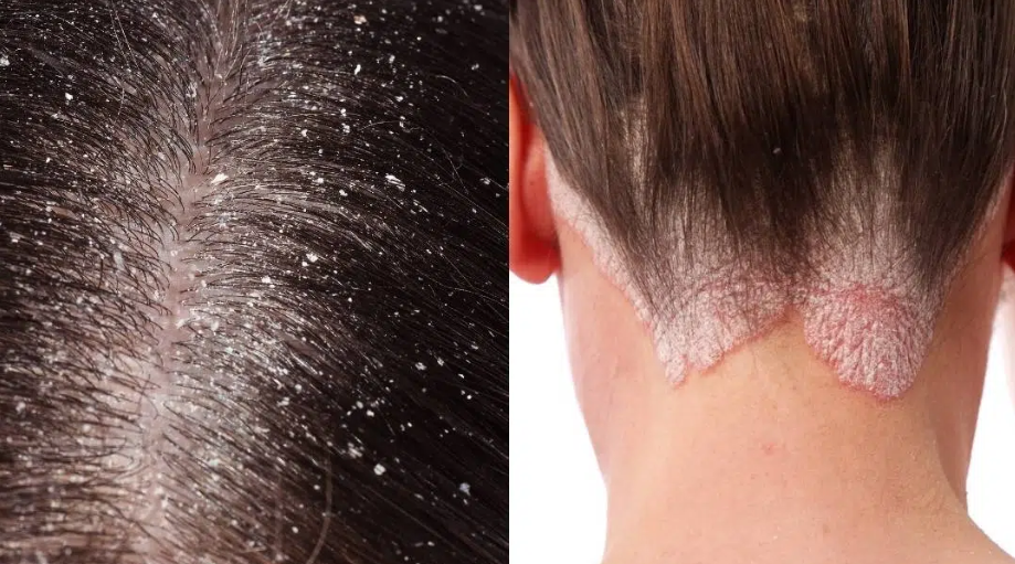 These tips help against an itchy scalp and flakes