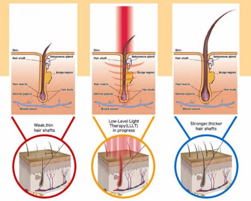 Laser Therapy for Hair Growth: An Innovative Solution to Hair Loss