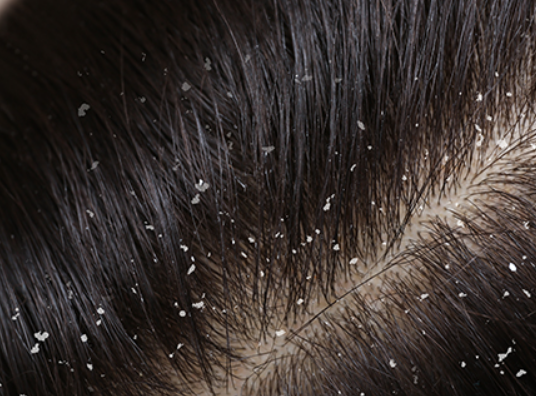 Best Scalp Treatment for Dandruff